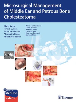 cover image of Microsurgical Management of Middle Ear and Petrous Bone Cholesteatoma